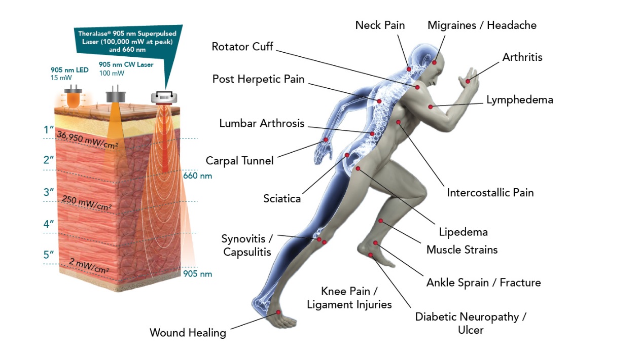 Photodynamic therapy tissue penetration and diabetic neuropathy treatment areas